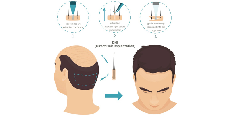 Direct-Hair-Implantation-DHI