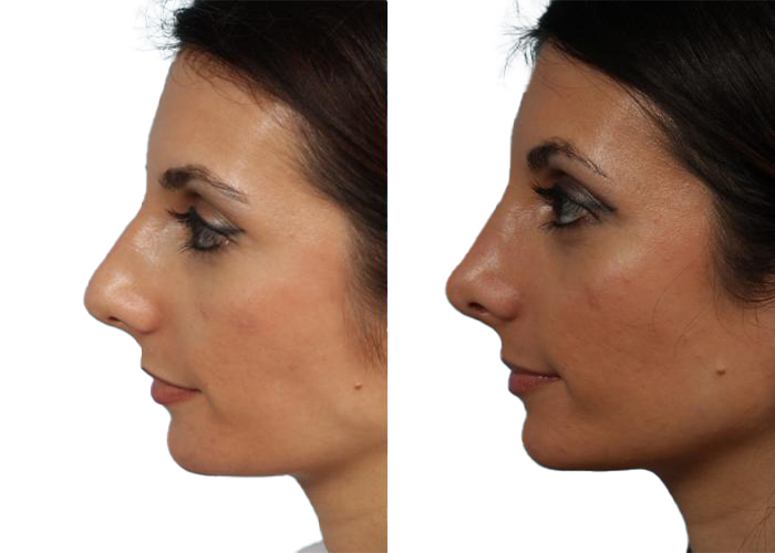 rhinoplasty plastic surgery in turkey