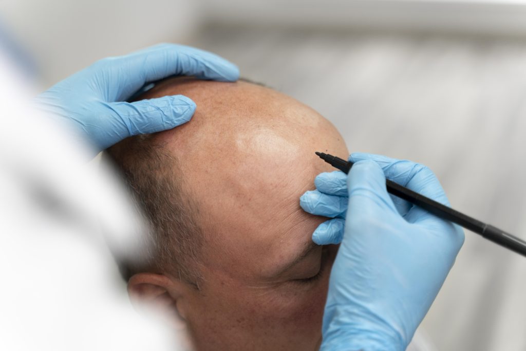 Hair transplant in Turkey