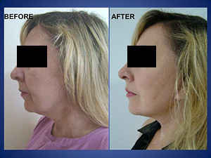 Cosmetic Treatment in Turkey