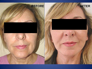Plastic Surgery in Turkey