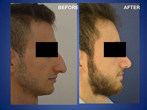 Rhinoplasty in Turkey