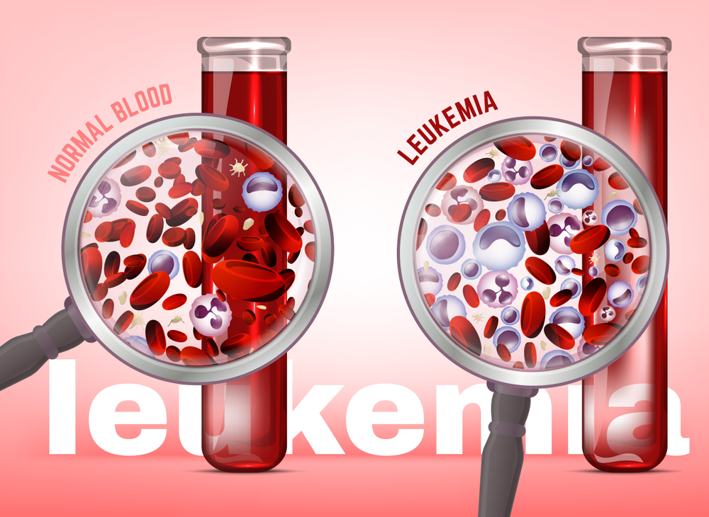 Improving Outcomes and Expanding Opportunities for the Treatment of Leukemia – LifeLine Turkey