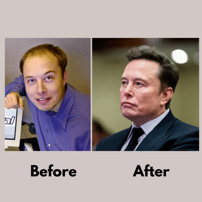 Elon Musk Hair Transplant: Before and After, Hair Loss, and the Transformation Everyone Noticed