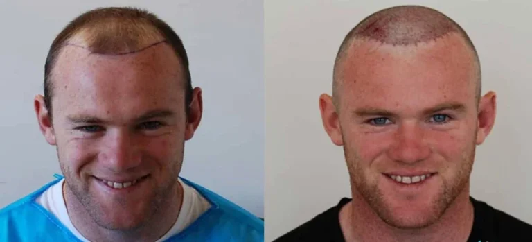 Wayne Rooney Hair Transplant: Before, After & Everything You Should Know